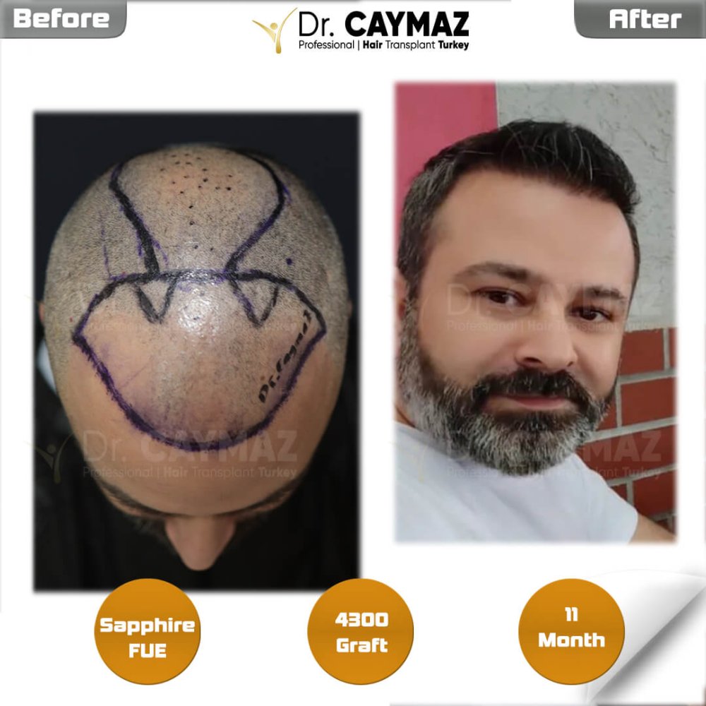 Hair transplant before & after result — frontal, kopfoberseite, 4,300 grafts, Sapphire FUE, 18 months post-op, Norwood 4 — Dr. Erkam Caymaz, Istanbul