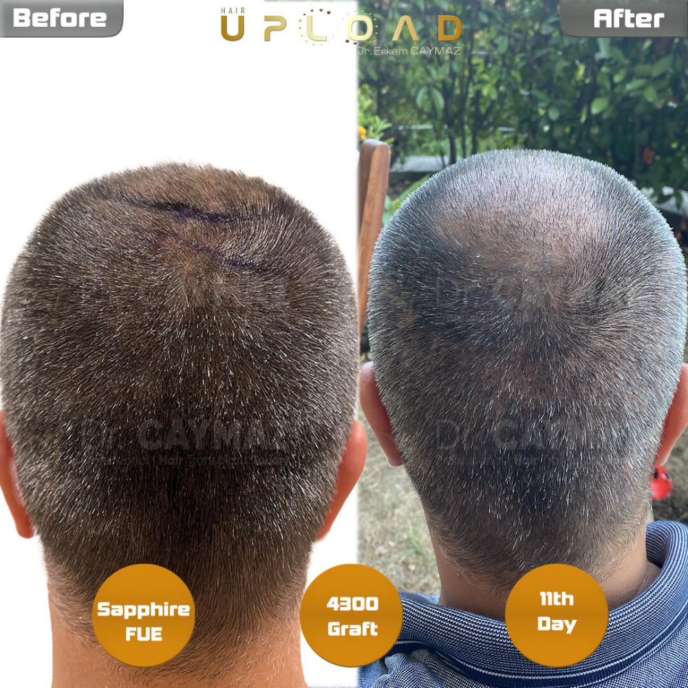 Hair transplant before & after result — frontal, kopfoberseite, 4,300 grafts, Sapphire FUE, 18 months post-op, Norwood 4 — Dr. Erkam Caymaz, Istanbul