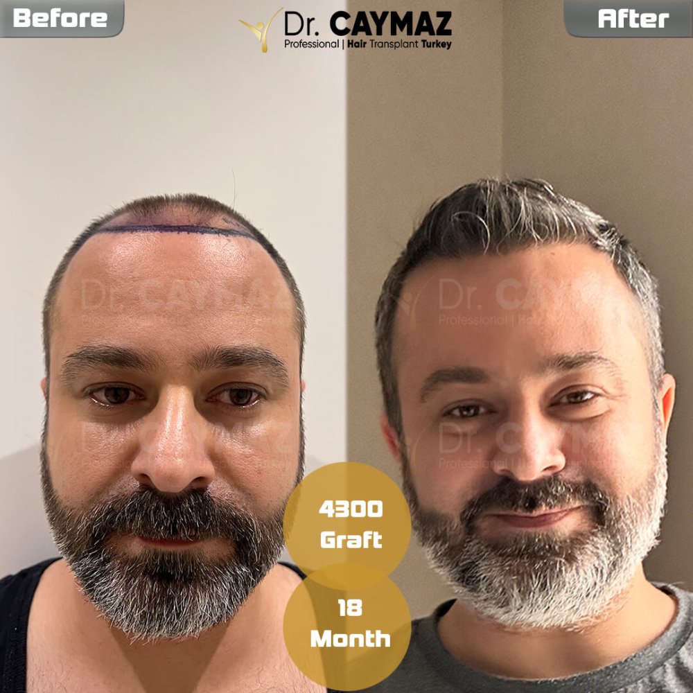 Hair transplant before & after result — frontal, kopfoberseite, 4,300 grafts, Sapphire FUE, 18 months post-op, Norwood 4 — Dr. Erkam Caymaz, Istanbul