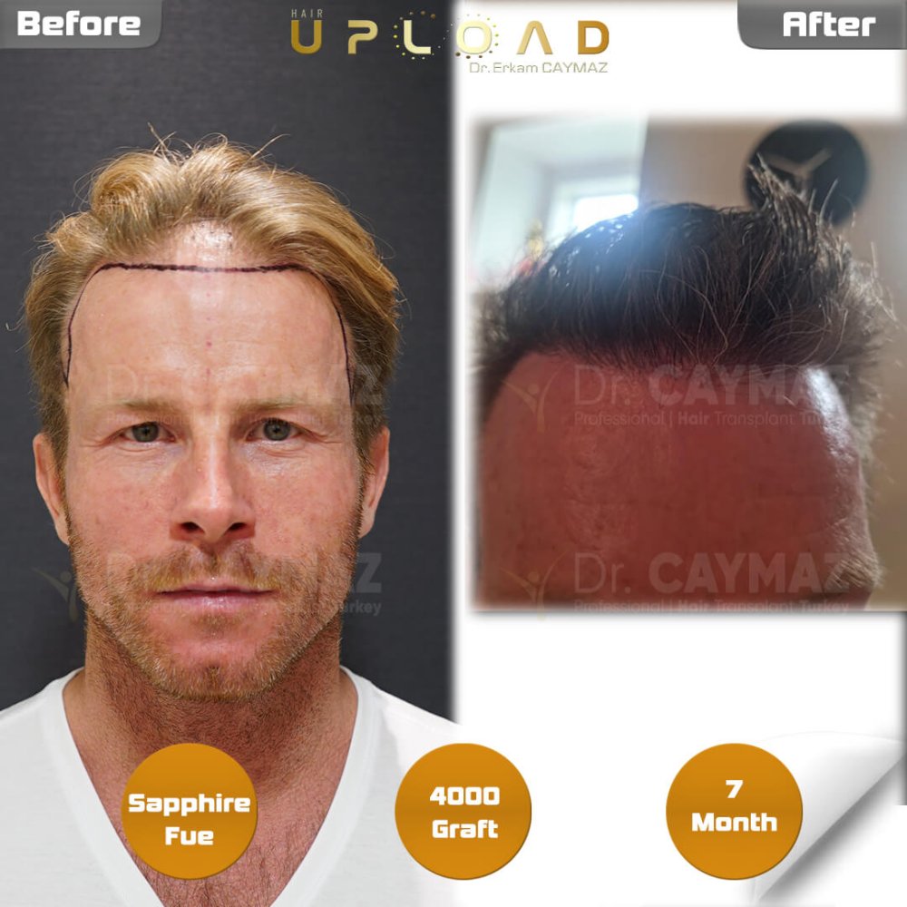 Hair transplant before & after result — frontal, kopfoberseite, 4,000 grafts, Sapphire FUE, 7 months post-op, Norwood 4 — Dr. Erkam Caymaz, Istanbul