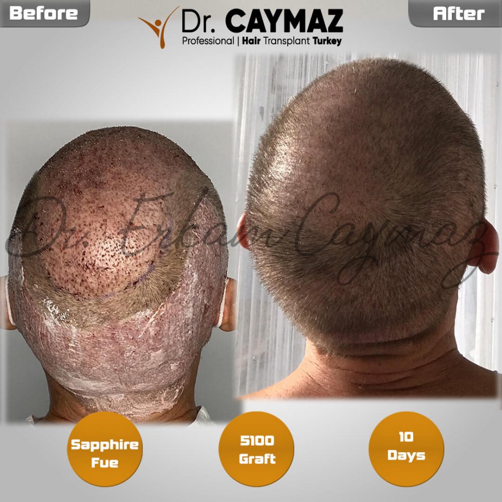 Hair transplant before & after result — frontal, parte superior, sienes, 5,100 grafts, Sapphire FUE, 5 months post-op, Norwood 5 — Dr. Erkam Caymaz, Istanbul