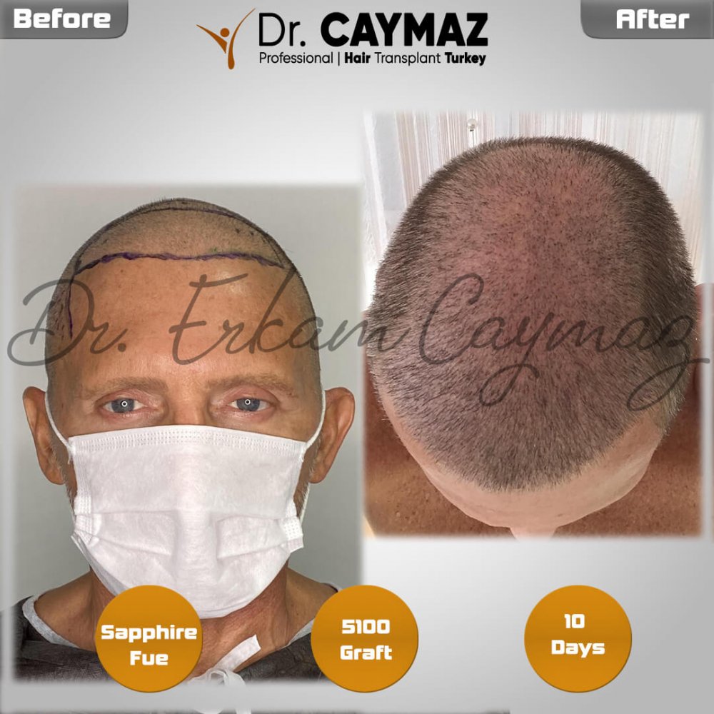 Hair transplant before & after result — frontal, parte superior, sienes, 5,100 grafts, Sapphire FUE, 5 months post-op, Norwood 5 — Dr. Erkam Caymaz, Istanbul