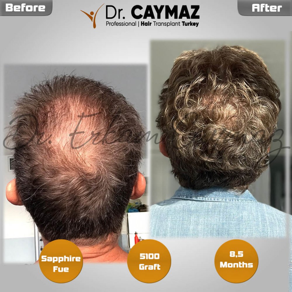 Hair transplant before & after result — frontal, parte superior, sienes, 5,100 grafts, Sapphire FUE, 5 months post-op, Norwood 5 — Dr. Erkam Caymaz, Istanbul