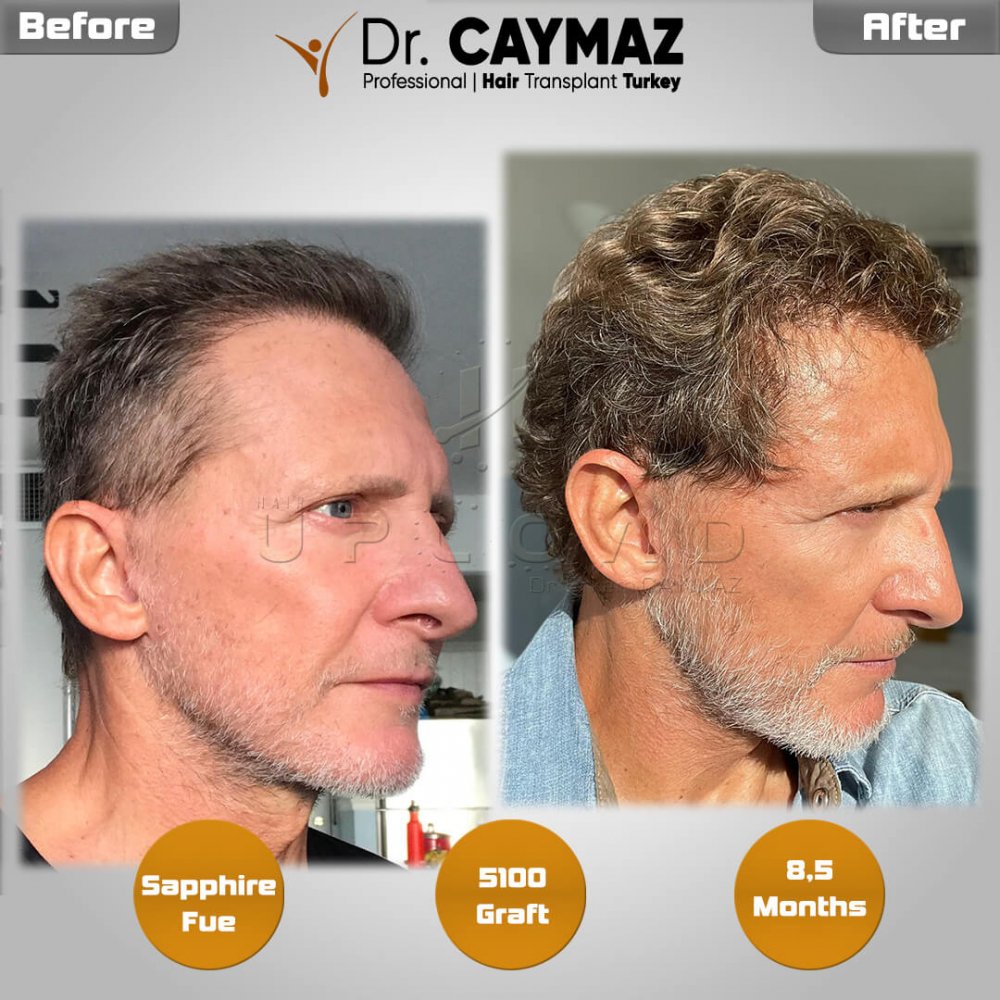 Hair transplant before & after result — frontal, parte superior, sienes, 5,100 grafts, Sapphire FUE, 5 months post-op, Norwood 5 — Dr. Erkam Caymaz, Istanbul