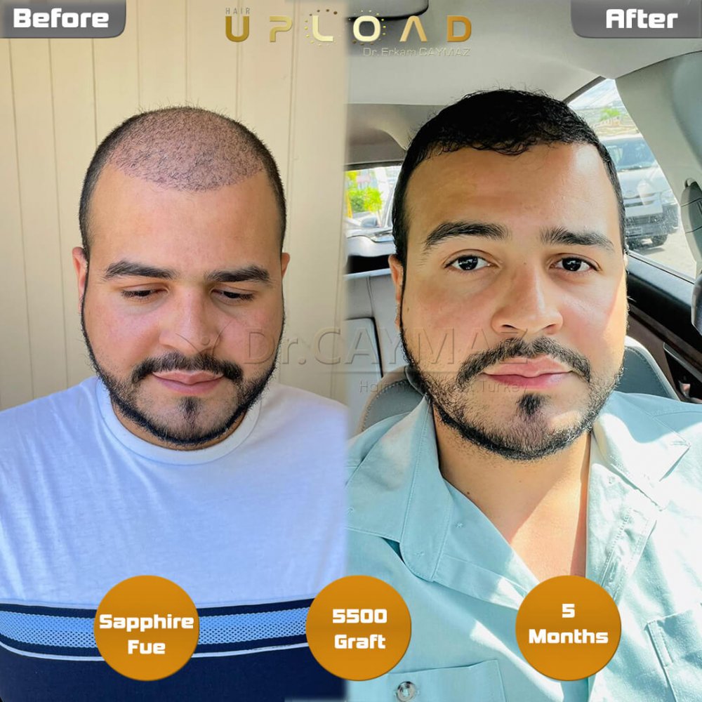 Hair transplant before & after result — frontal, top of head, crown, 5,500 grafts, Sapphire FUE, 5 months post-op, Norwood 5 — Dr. Erkam Caymaz, Istanbul