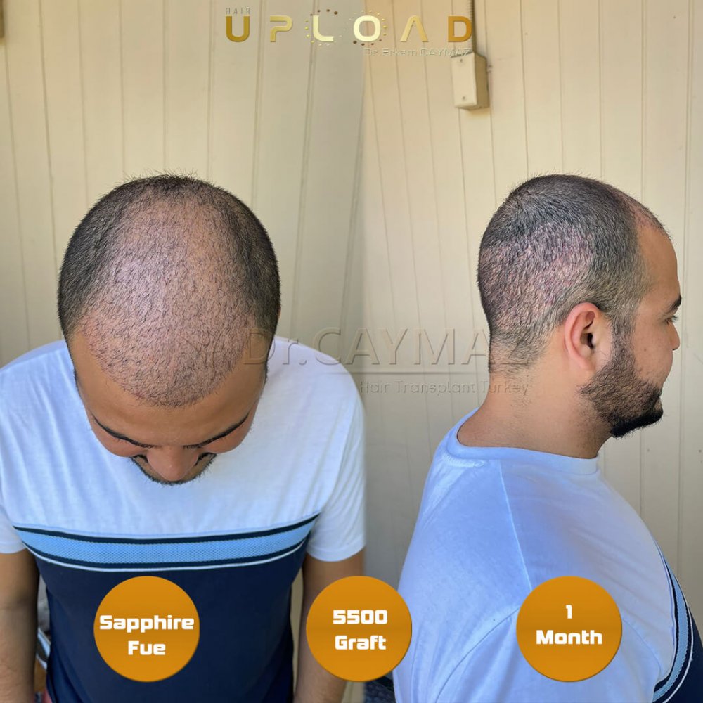 Hair transplant before & after result — frontal, top of head, crown, 5,500 grafts, Sapphire FUE, 5 months post-op, Norwood 5 — Dr. Erkam Caymaz, Istanbul
