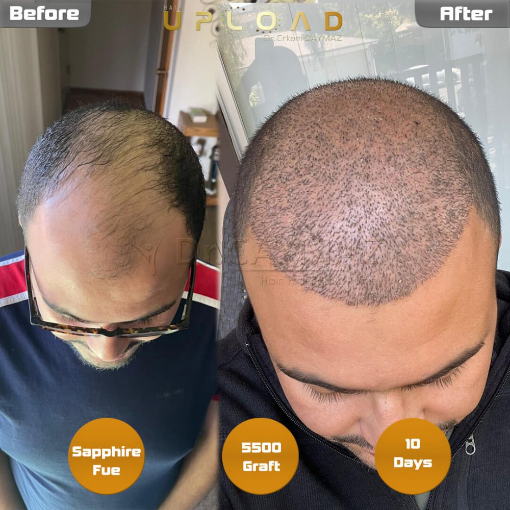Hair transplant before & after result — frontal, top of head, crown, 5,500 grafts, Sapphire FUE, 5 months post-op, Norwood 5 — Dr. Erkam Caymaz, Istanbul