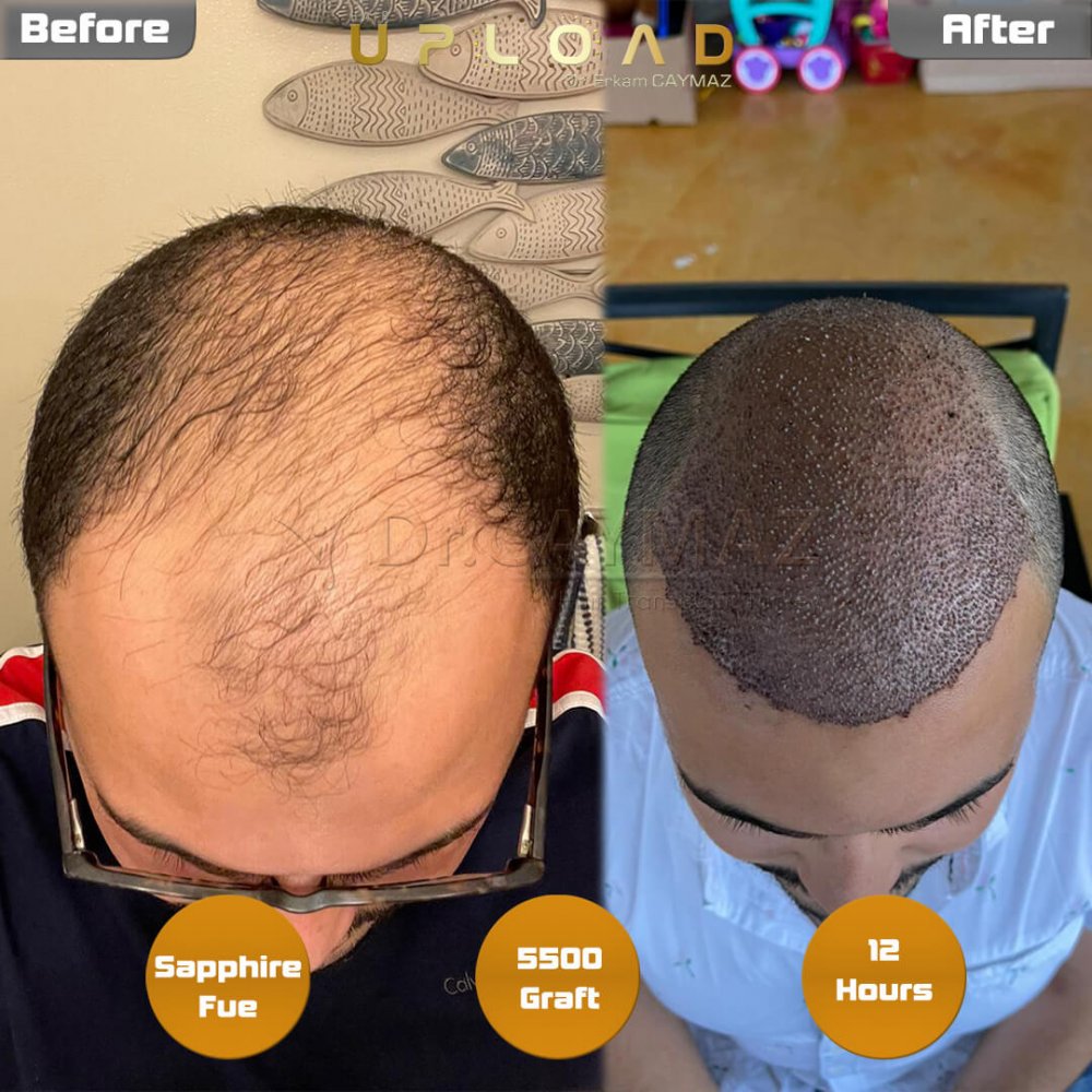 Hair transplant before & after result — frontal, top of head, crown, 5,500 grafts, Sapphire FUE, 5 months post-op, Norwood 5 — Dr. Erkam Caymaz, Istanbul