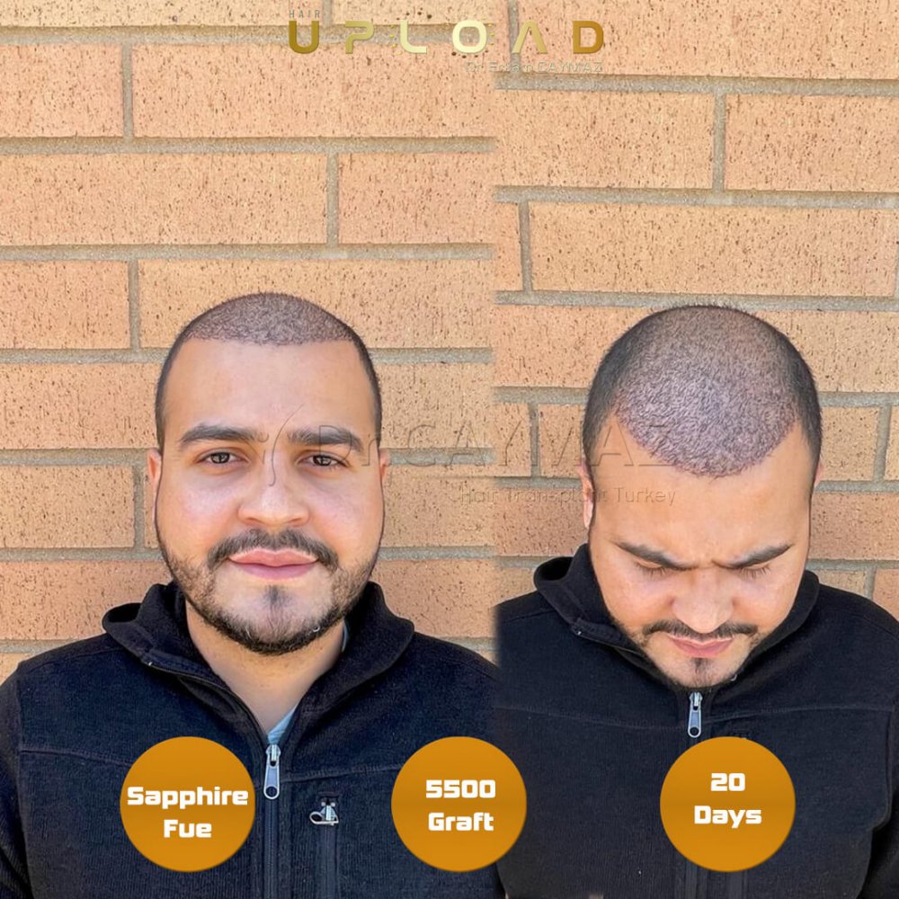 Hair transplant before & after result — frontal, top of head, crown, 5,500 grafts, Sapphire FUE, 5 months post-op, Norwood 5 — Dr. Erkam Caymaz, Istanbul