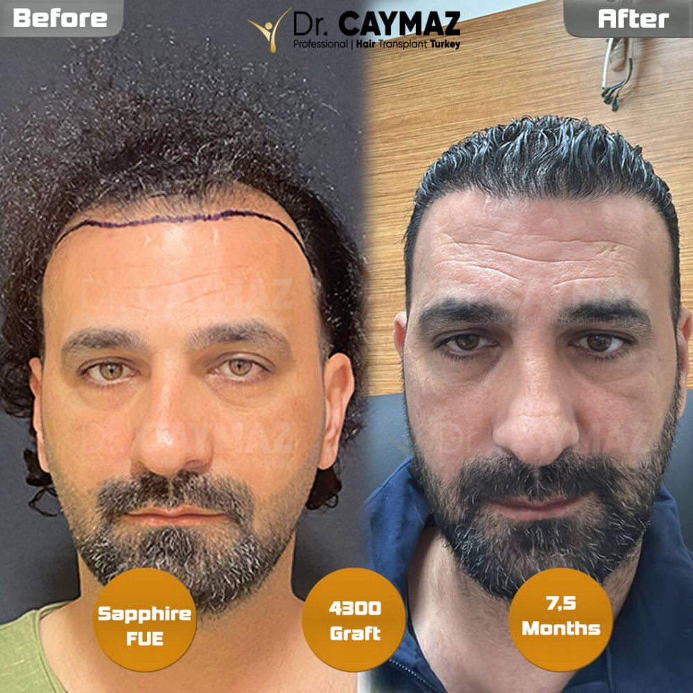 Hair transplant before & after result — frontal, kopfoberseite, kronenregion, 4,300 grafts, Sapphire FUE, 8 months post-op, Norwood 5 — Dr. Erkam Caymaz, Istanbul
