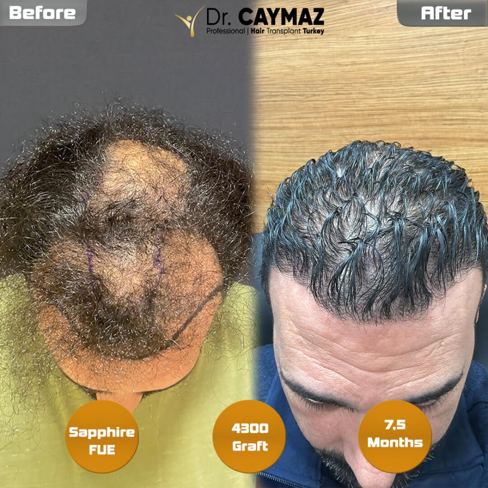 Hair transplant before & after result — frontal, kopfoberseite, kronenregion, 4,300 grafts, Sapphire FUE, 8 months post-op, Norwood 5 — Dr. Erkam Caymaz, Istanbul