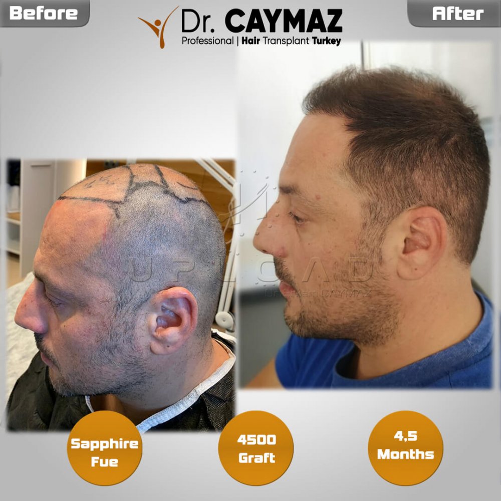 Hair transplant before & after result — frontal, parte superior, corona, 4,500 grafts, Sapphire FUE, 8 months post-op, Norwood 6 — Dr. Erkam Caymaz, Istanbul