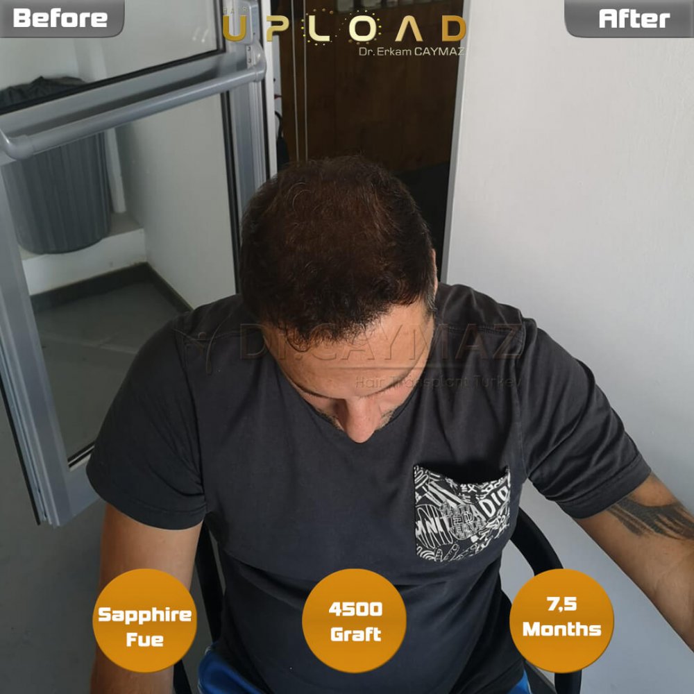 Hair transplant before & after result — frontal, parte superior, corona, 4,500 grafts, Sapphire FUE, 8 months post-op, Norwood 6 — Dr. Erkam Caymaz, Istanbul
