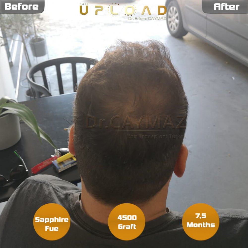 Hair transplant before & after result — frontal, parte superior, corona, 4,500 grafts, Sapphire FUE, 8 months post-op, Norwood 6 — Dr. Erkam Caymaz, Istanbul