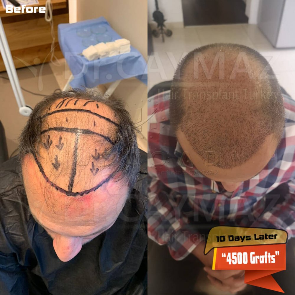 Hair transplant before & after result — frontal, parte superior, corona, 4,500 grafts, Sapphire FUE, 8 months post-op, Norwood 6 — Dr. Erkam Caymaz, Istanbul
