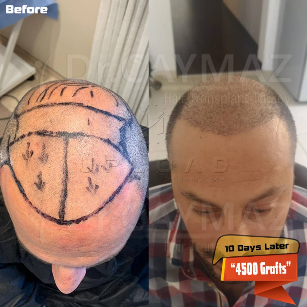 Hair transplant before & after result — frontal, parte superior, corona, 4,500 grafts, Sapphire FUE, 8 months post-op, Norwood 6 — Dr. Erkam Caymaz, Istanbul