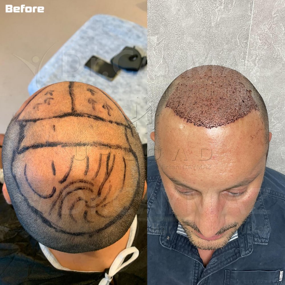 Hair transplant before & after result — frontal, parte superior, corona, 4,500 grafts, Sapphire FUE, 8 months post-op, Norwood 6 — Dr. Erkam Caymaz, Istanbul