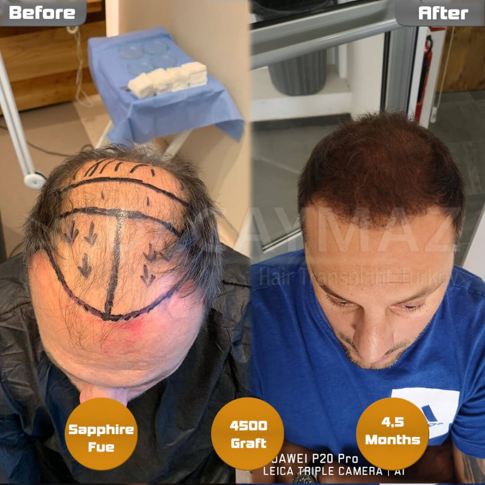 Hair transplant before & after result — frontal, parte superior, corona, 4,500 grafts, Sapphire FUE, 8 months post-op, Norwood 6 — Dr. Erkam Caymaz, Istanbul