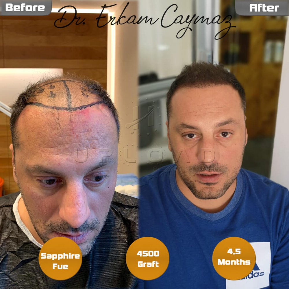 Hair transplant before & after result — frontal, parte superior, corona, 4,500 grafts, Sapphire FUE, 8 months post-op, Norwood 6 — Dr. Erkam Caymaz, Istanbul
