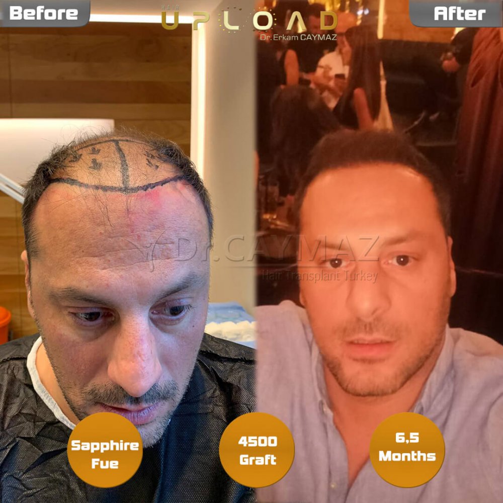 Hair transplant before & after result — frontal, parte superior, corona, 4,500 grafts, Sapphire FUE, 8 months post-op, Norwood 6 — Dr. Erkam Caymaz, Istanbul