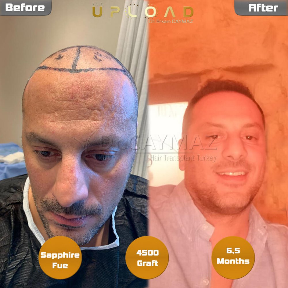 Hair transplant before & after result — frontal, parte superior, corona, 4,500 grafts, Sapphire FUE, 8 months post-op, Norwood 6 — Dr. Erkam Caymaz, Istanbul