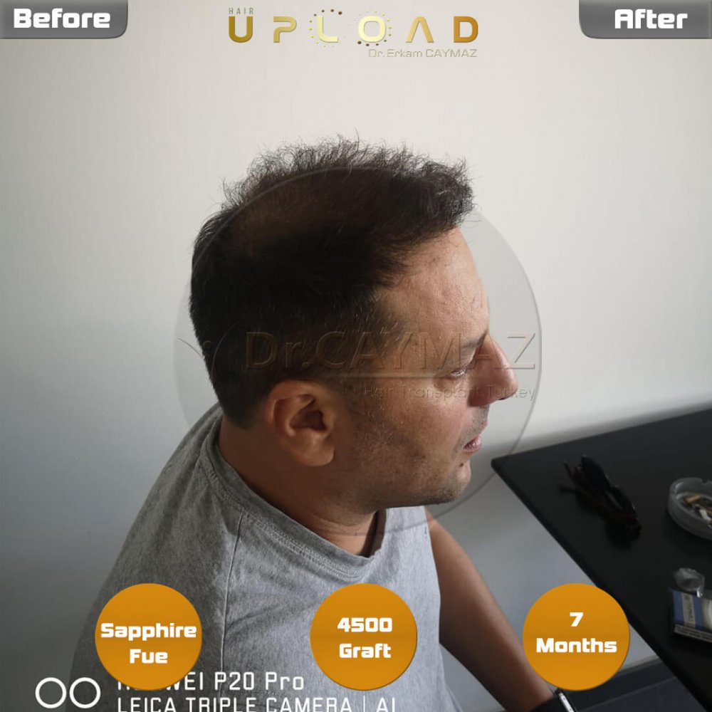 Hair transplant before & after result — frontal, parte superior, corona, 4,500 grafts, Sapphire FUE, 8 months post-op, Norwood 6 — Dr. Erkam Caymaz, Istanbul