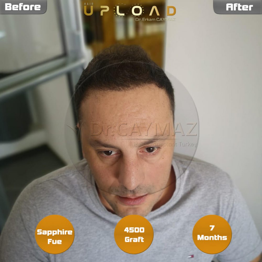 Hair transplant before & after result — frontal, parte superior, corona, 4,500 grafts, Sapphire FUE, 8 months post-op, Norwood 6 — Dr. Erkam Caymaz, Istanbul