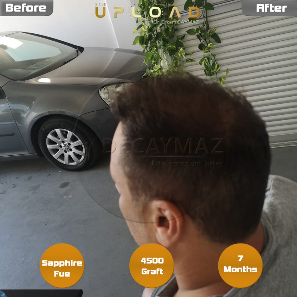 Hair transplant before & after result — frontal, parte superior, corona, 4,500 grafts, Sapphire FUE, 8 months post-op, Norwood 6 — Dr. Erkam Caymaz, Istanbul