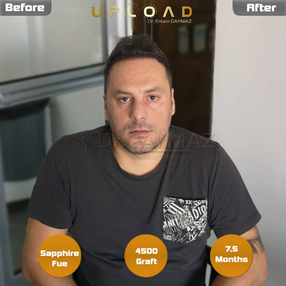 Hair transplant before & after result — frontal, parte superior, corona, 4,500 grafts, Sapphire FUE, 8 months post-op, Norwood 6 — Dr. Erkam Caymaz, Istanbul