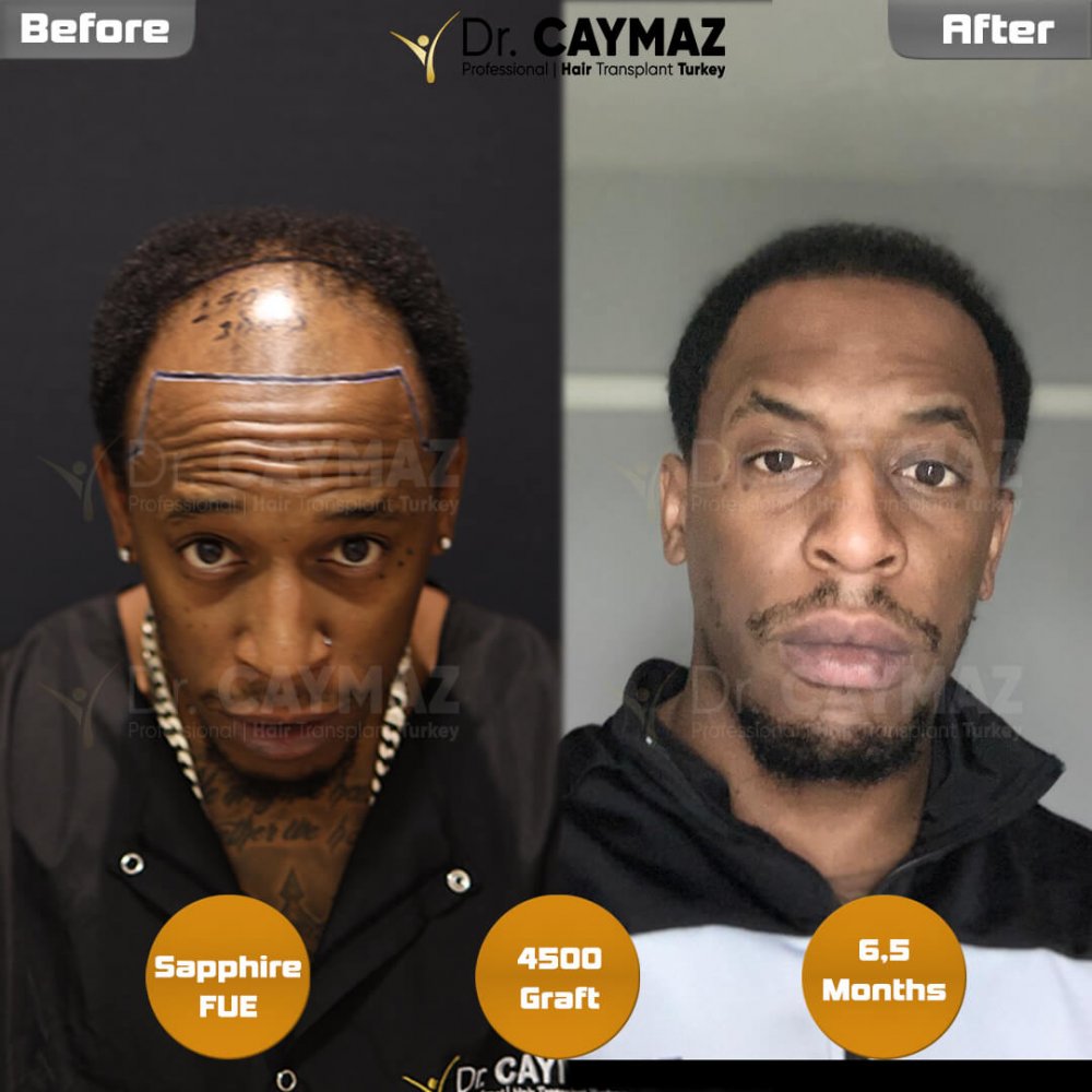 Hair transplant before & after result — frontal, top of head, 4,500 grafts, Sapphire FUE, 6 months post-op, Norwood 4 — Dr. Erkam Caymaz, Istanbul
