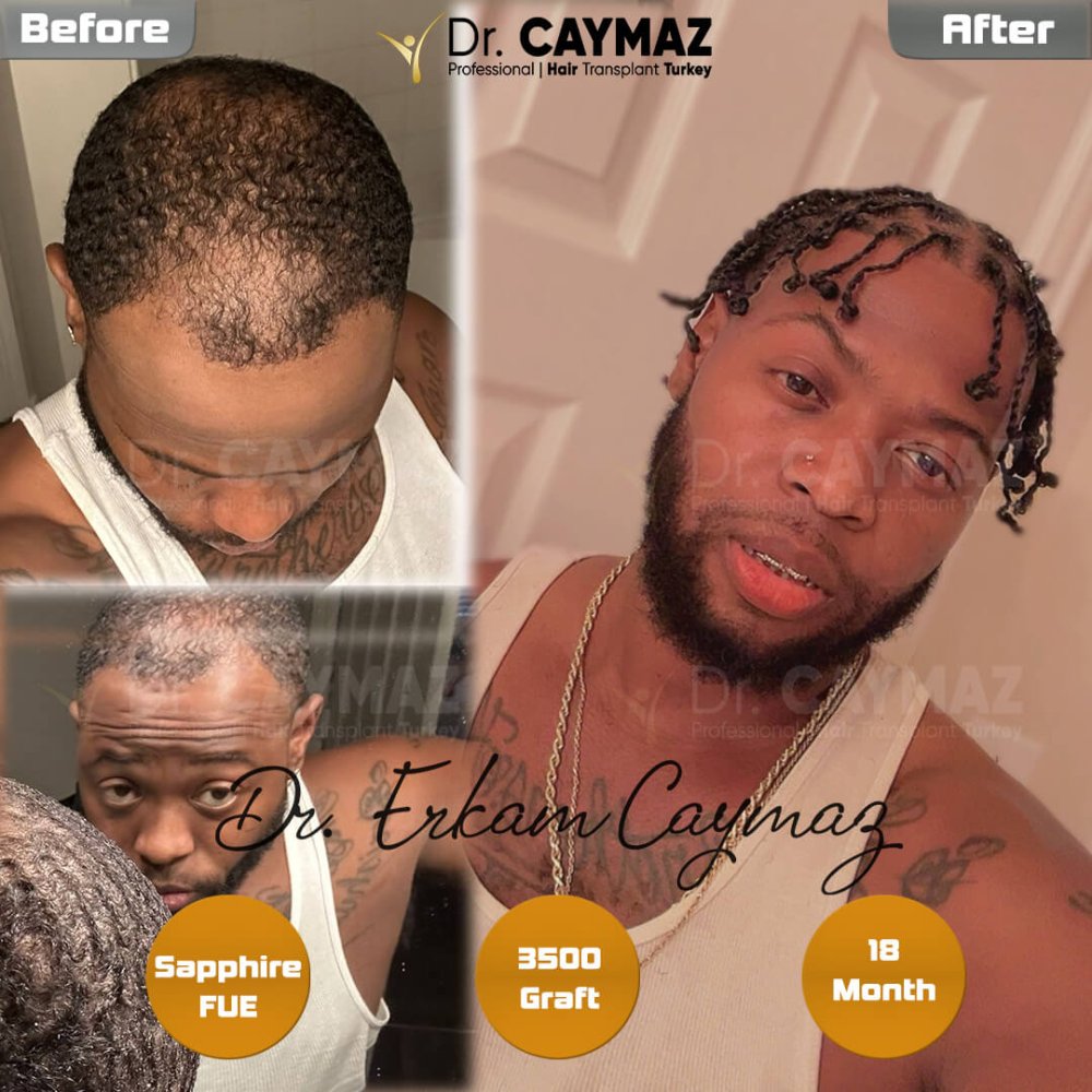 Hair transplant before & after result — frontal, kopfoberseite, schläfen, 3,500 grafts, Sapphire FUE, 18 months post-op, Norwood 3 — Dr. Erkam Caymaz, Istanbul