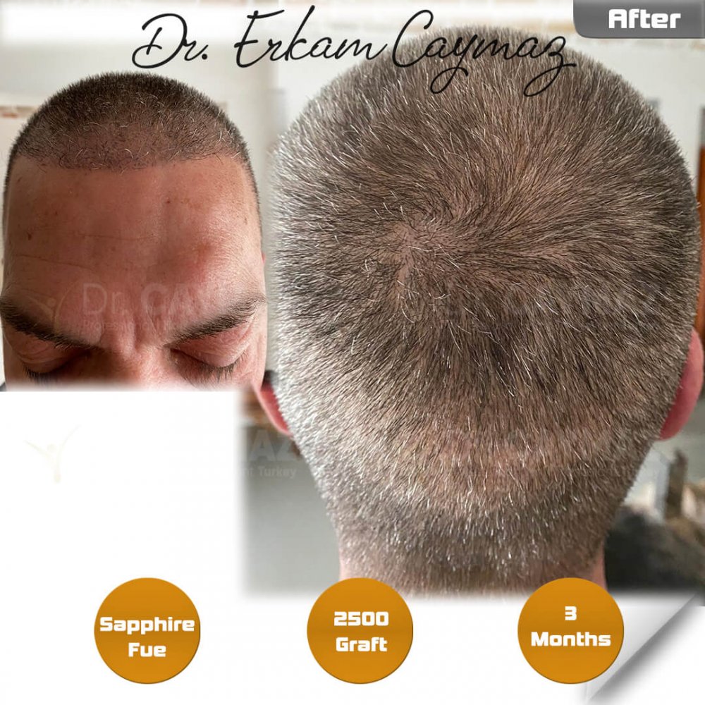 Hair transplant before & after result — frontal, 2,500 grafts, Sapphire FUE, 10 months post-op, Norwood 2 — Dr. Erkam Caymaz, Istanbul