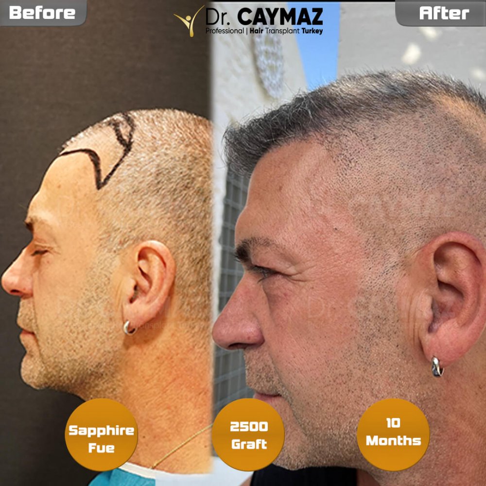Hair transplant before & after result — frontal, 2,500 grafts, Sapphire FUE, 10 months post-op, Norwood 2 — Dr. Erkam Caymaz, Istanbul