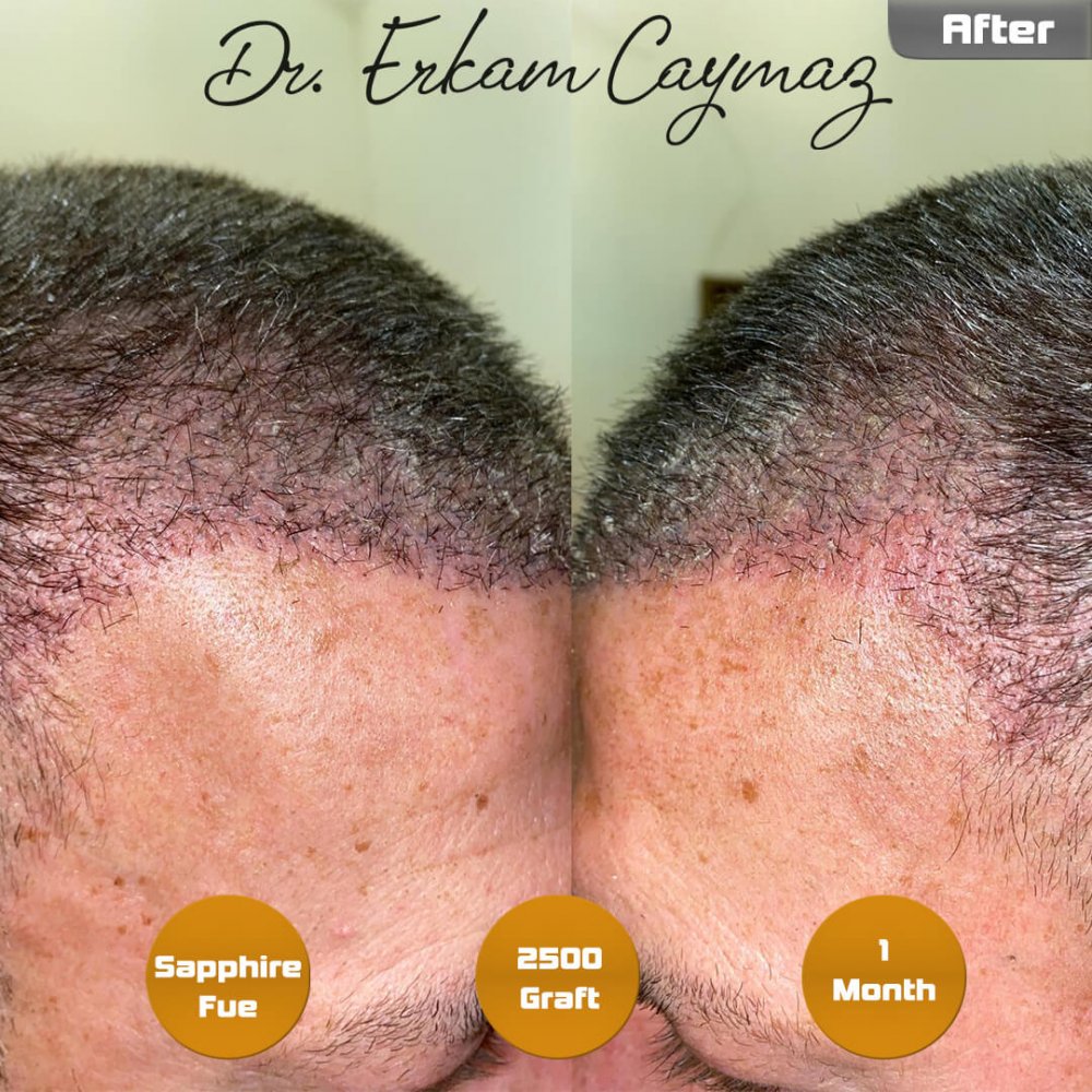 Hair transplant before & after result — frontal, 2,500 grafts, Sapphire FUE, 10 months post-op, Norwood 2 — Dr. Erkam Caymaz, Istanbul