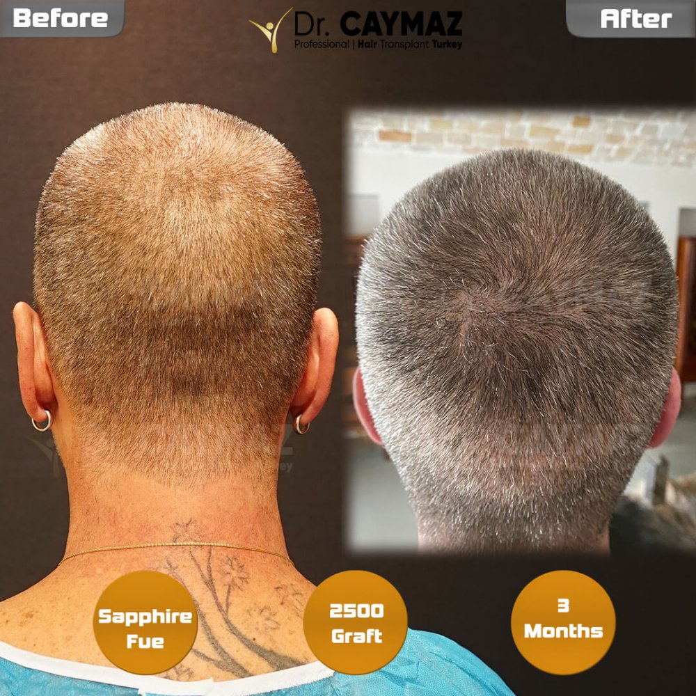 Hair transplant before & after result — frontal, 2,500 grafts, Sapphire FUE, 10 months post-op, Norwood 2 — Dr. Erkam Caymaz, Istanbul