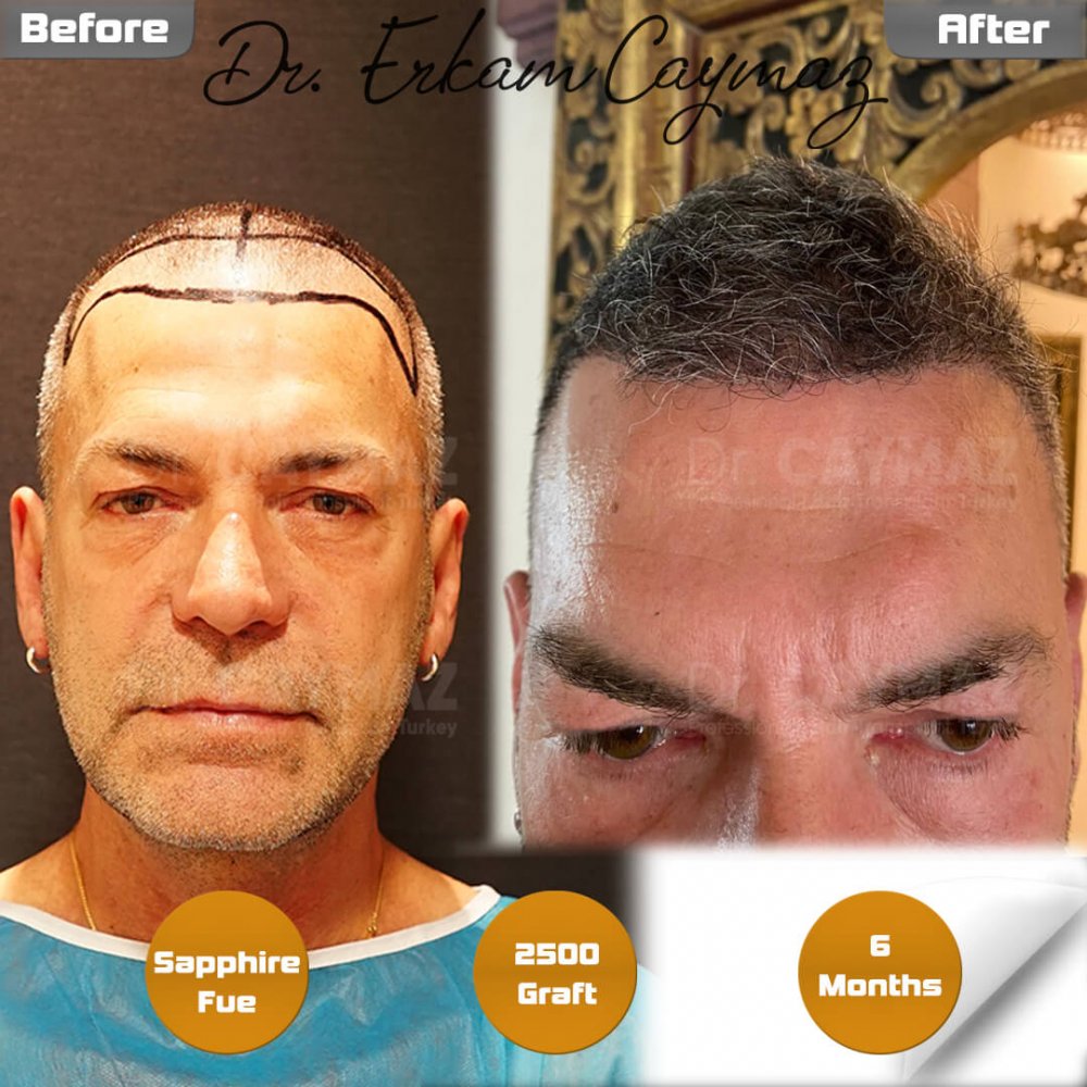 Hair transplant before & after result — frontal, 2,500 grafts, Sapphire FUE, 10 months post-op, Norwood 2 — Dr. Erkam Caymaz, Istanbul