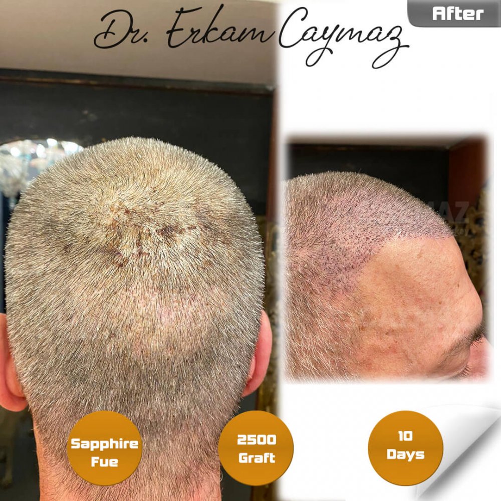 Hair transplant before & after result — frontal, 2,500 grafts, Sapphire FUE, 10 months post-op, Norwood 2 — Dr. Erkam Caymaz, Istanbul