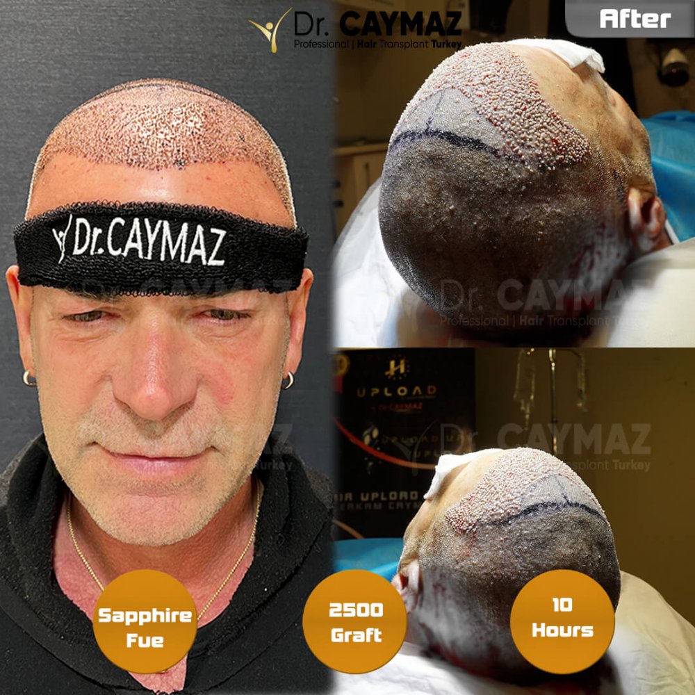 Hair transplant before & after result — frontal, 2,500 grafts, Sapphire FUE, 10 months post-op, Norwood 2 — Dr. Erkam Caymaz, Istanbul