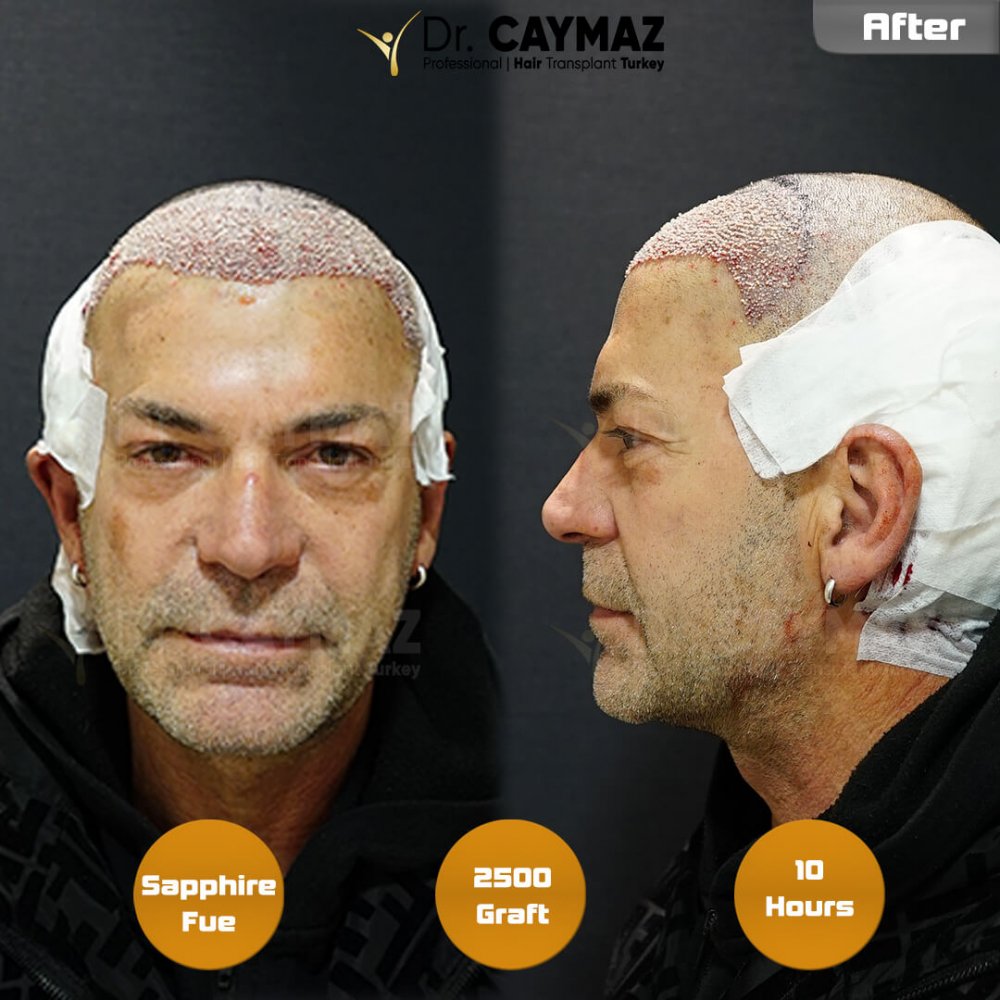 Hair transplant before & after result — frontal, 2,500 grafts, Sapphire FUE, 10 months post-op, Norwood 2 — Dr. Erkam Caymaz, Istanbul