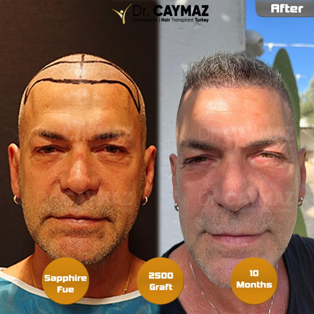 Hair transplant before & after result — frontal, 2,500 grafts, Sapphire FUE, 10 months post-op, Norwood 2 — Dr. Erkam Caymaz, Istanbul
