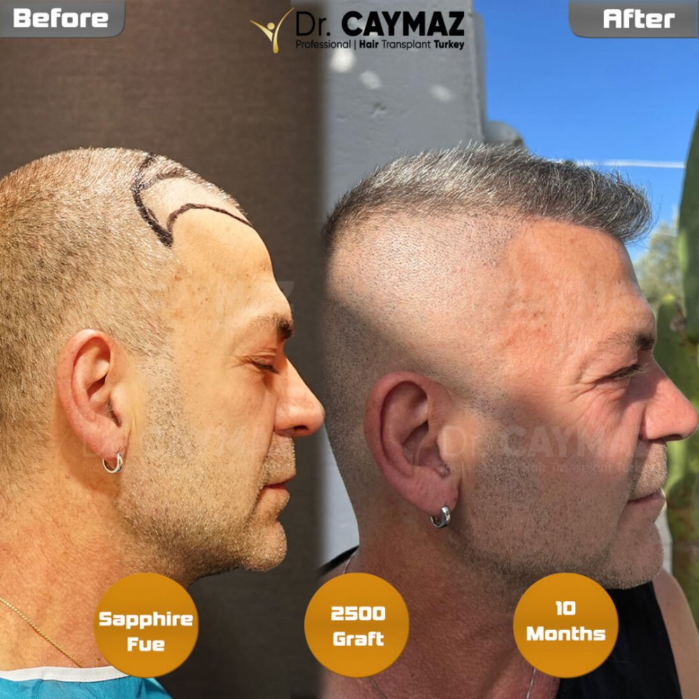 Hair transplant before & after result — frontal, 2,500 grafts, Sapphire FUE, 10 months post-op, Norwood 2 — Dr. Erkam Caymaz, Istanbul