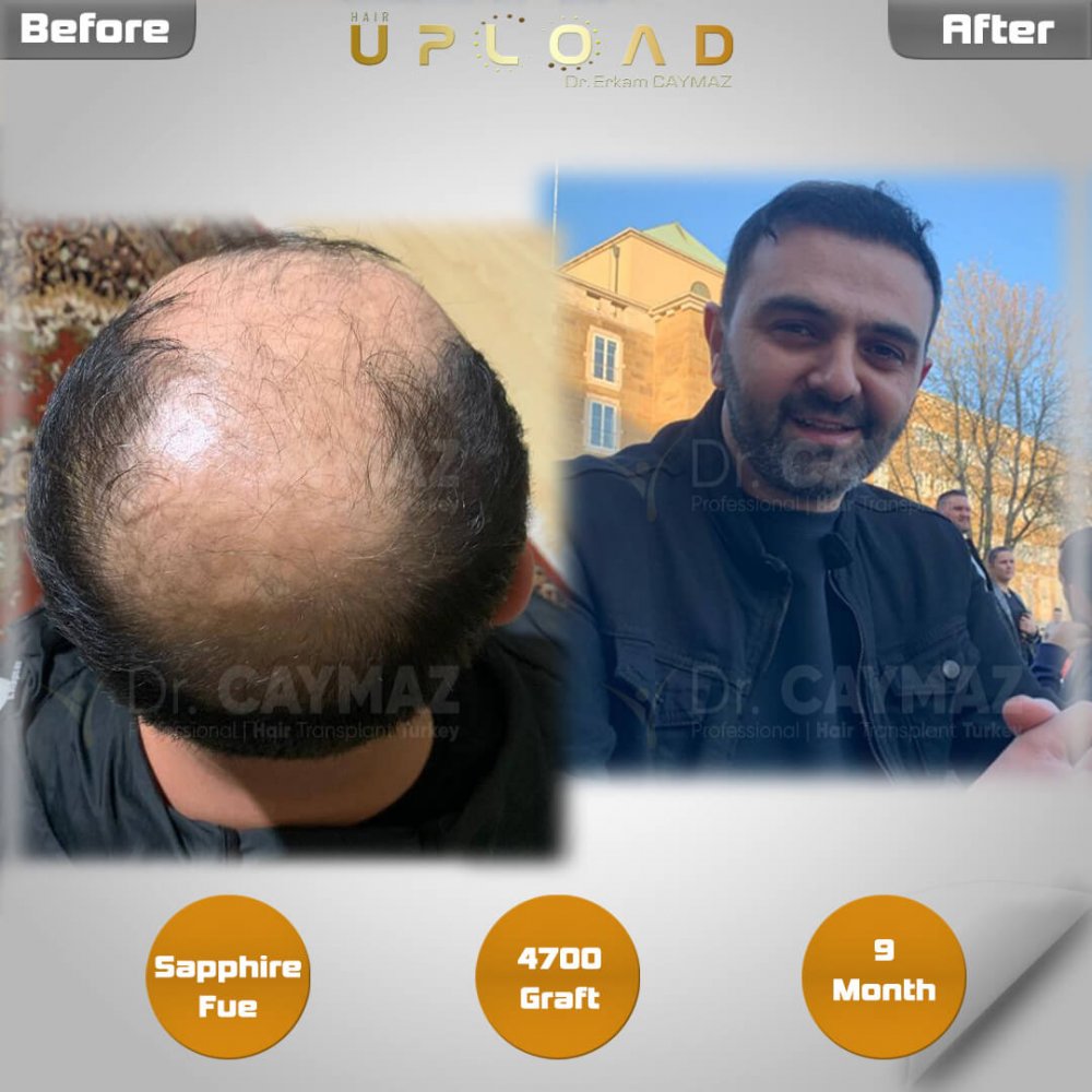 Hair transplant before & after result — frontal, kopfoberseite, kronenregion, 4,700 grafts, Sapphire FUE, 9 months post-op, Norwood 6 — Dr. Erkam Caymaz, Istanbul