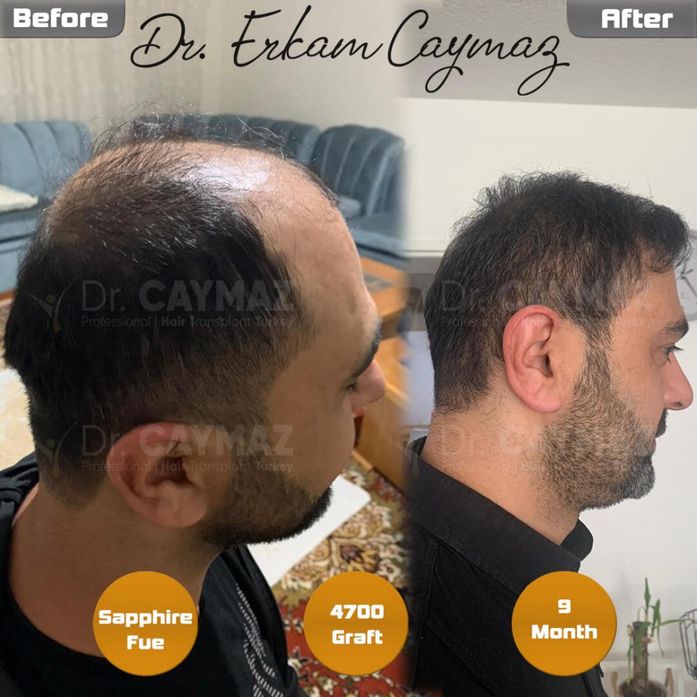 Hair transplant before & after result — frontal, kopfoberseite, kronenregion, 4,700 grafts, Sapphire FUE, 9 months post-op, Norwood 6 — Dr. Erkam Caymaz, Istanbul