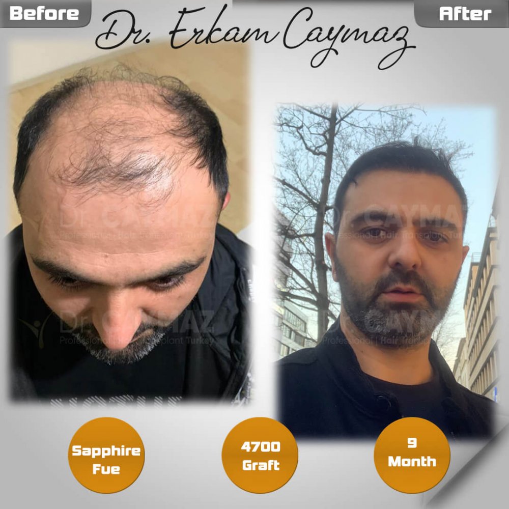 Hair transplant before & after result — frontal, kopfoberseite, kronenregion, 4,700 grafts, Sapphire FUE, 9 months post-op, Norwood 6 — Dr. Erkam Caymaz, Istanbul