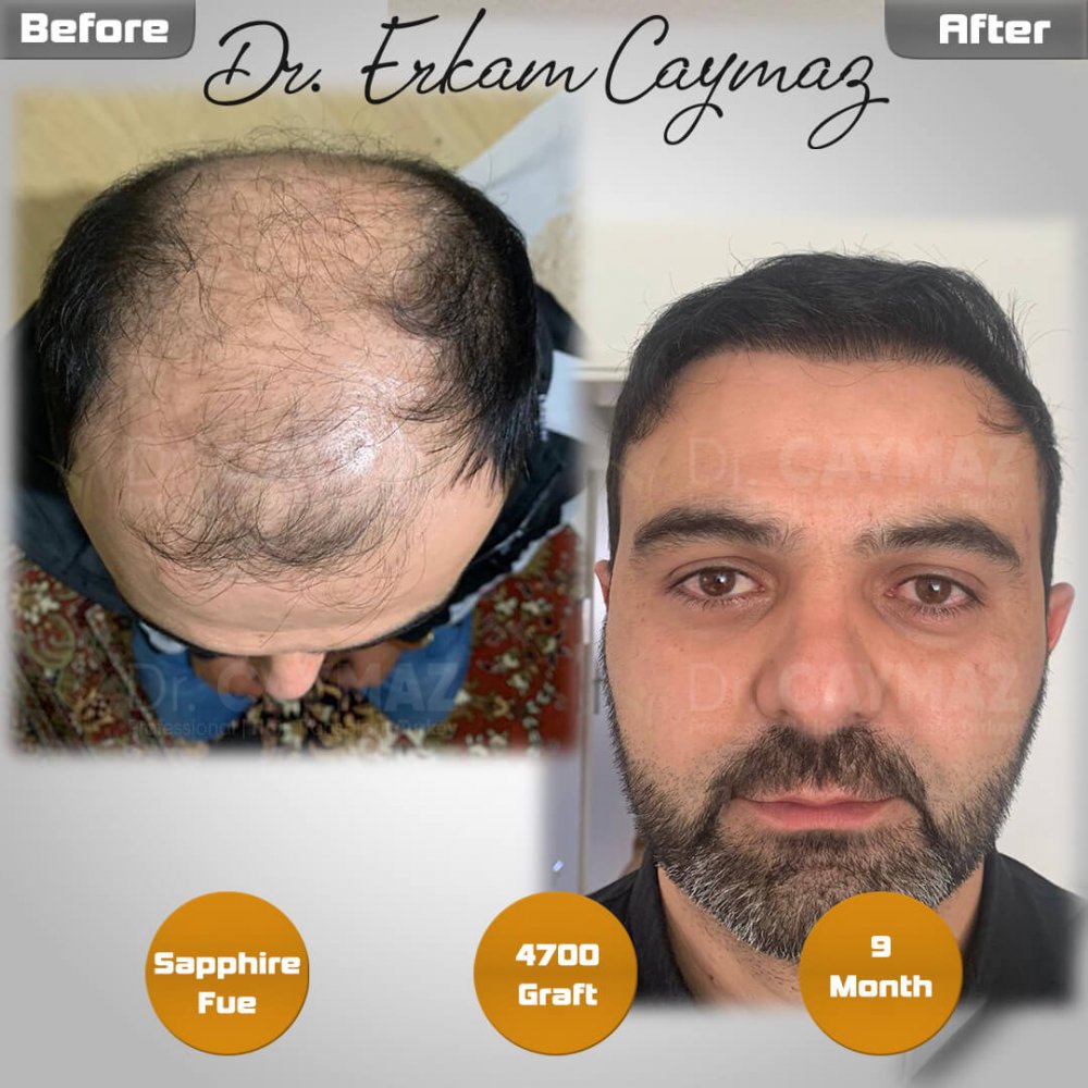 Hair transplant before & after result — frontal, kopfoberseite, kronenregion, 4,700 grafts, Sapphire FUE, 9 months post-op, Norwood 6 — Dr. Erkam Caymaz, Istanbul