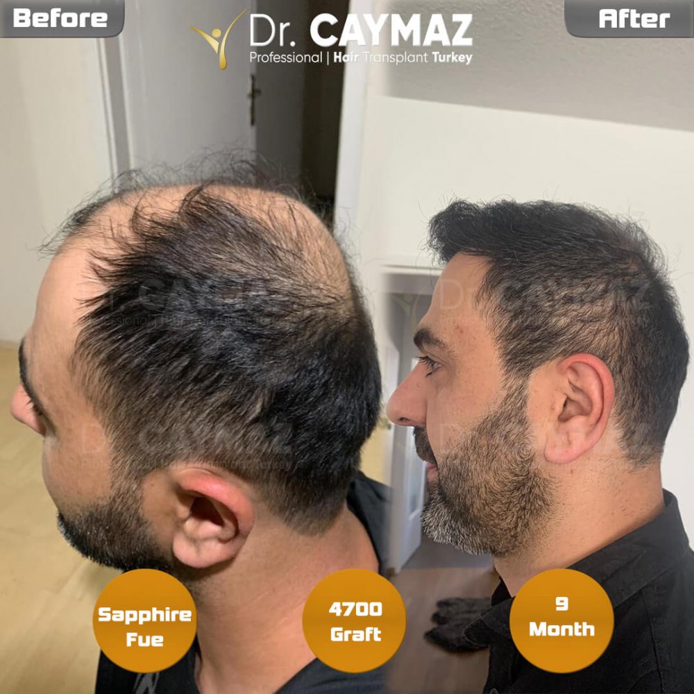Hair transplant before & after result — frontal, kopfoberseite, kronenregion, 4,700 grafts, Sapphire FUE, 9 months post-op, Norwood 6 — Dr. Erkam Caymaz, Istanbul