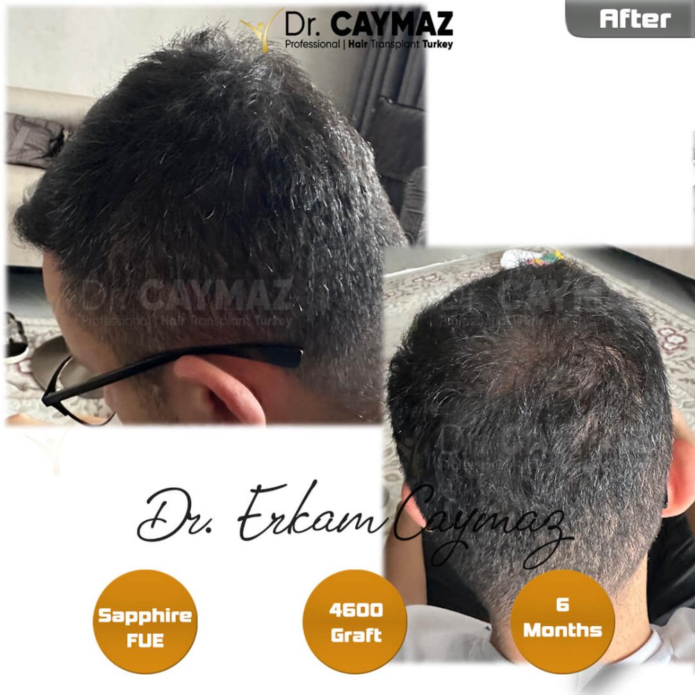 Hair transplant before & after result — frontal, kopfoberseite, kronenregion, 4,600 grafts, Sapphire FUE, 12 months post-op, Norwood 4 — Dr. Erkam Caymaz, Istanbul