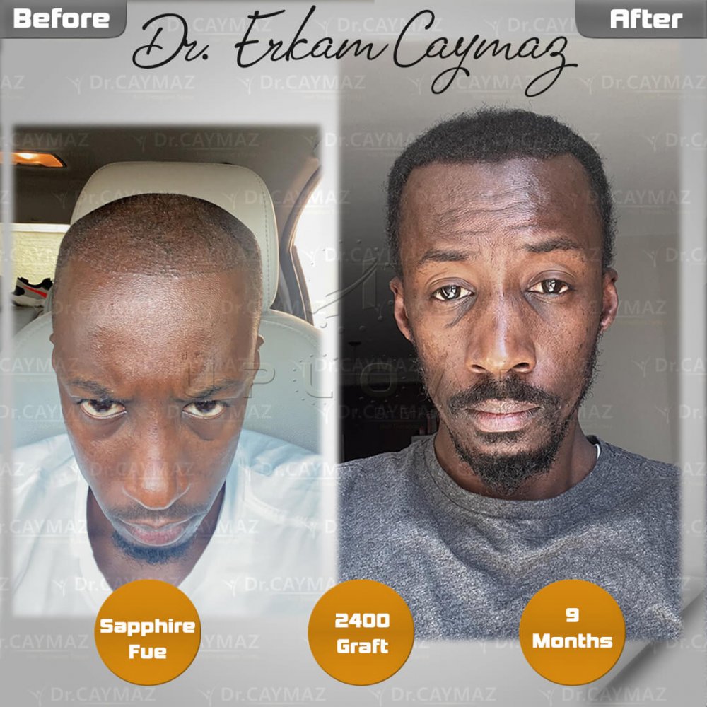 Mr.Mamadou - Afro - 2400 Graft - Sapphire Fue - 9 Months — hair transplant before & after — frontal, parte superior, 2,400 grafts, Sapphire FUE, 9 months post-op, Norwood 5 — Dr. Erkam Caymaz, Istanbul