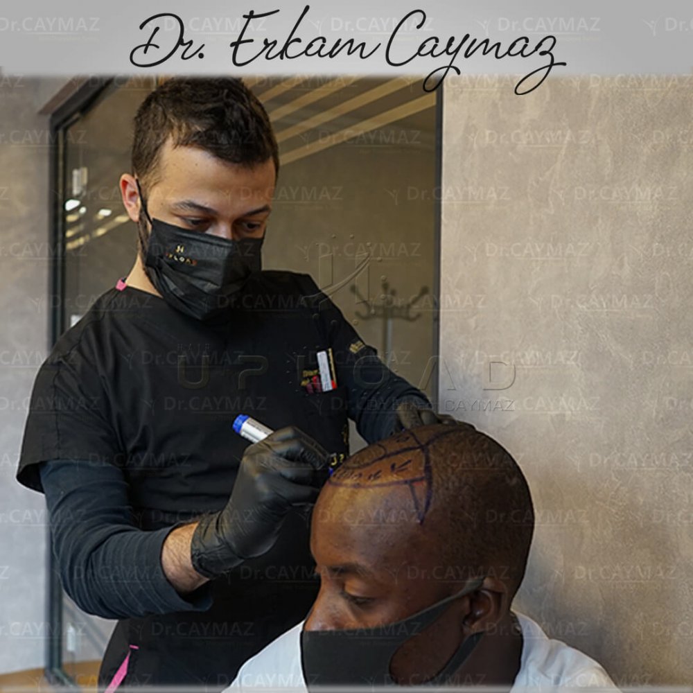 Mr.Mamadou - Afro - 2400 Graft - Sapphire Fue - 9 Months — hair transplant before & after — frontal, parte superior, 2,400 grafts, Sapphire FUE, 9 months post-op, Norwood 5 — Dr. Erkam Caymaz, Istanbul