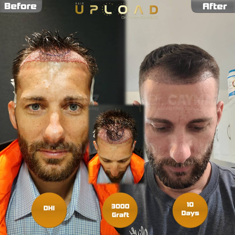 Hair transplant before & after result — frontal, 3,000 grafts, DHI, 7 months post-op, Norwood 3 — Dr. Erkam Caymaz, Istanbul